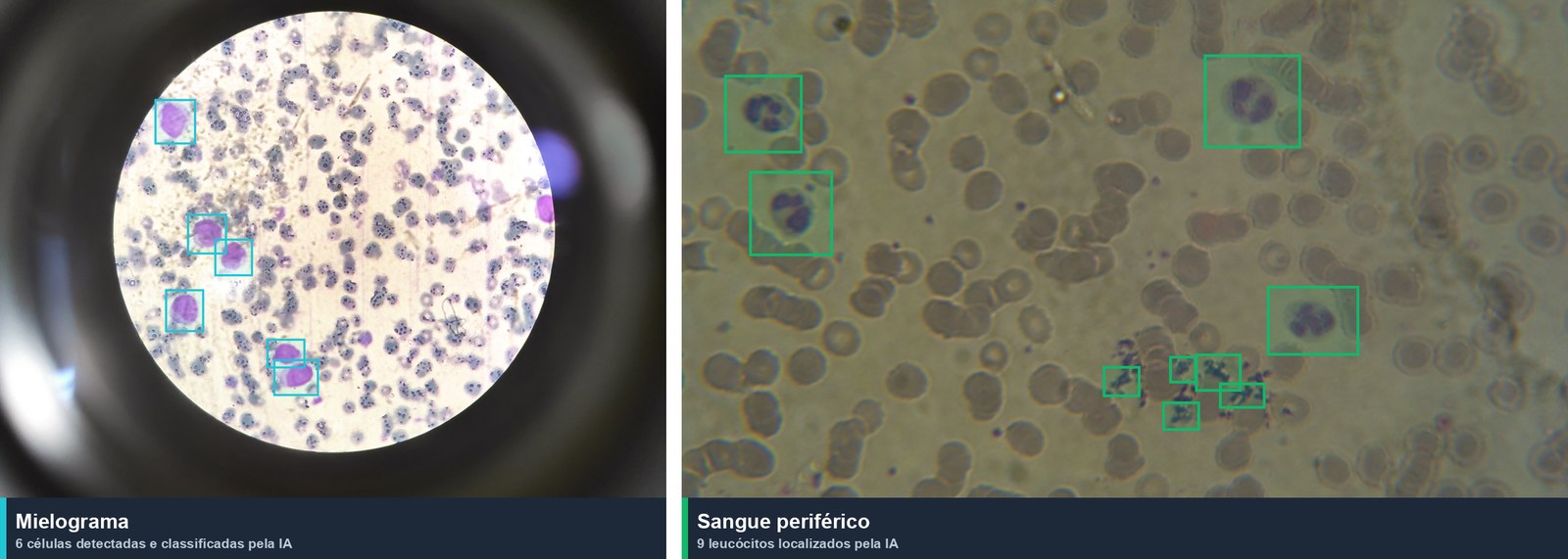 Detecções da IA em mielograma e sangue periférico